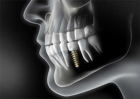 SW19 Confidental Clinic Dental Implants